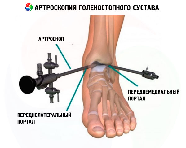 Boka MR :: Dr. Detre Zoltán - InforMed Orvosi és Életmód portál :: bokaszalag sérülés