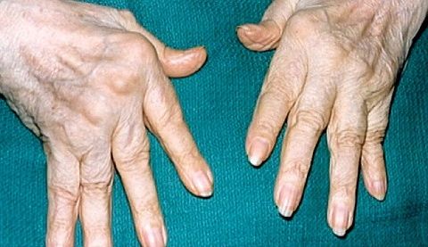 merevség és fájdalom az ujjak ízületeiben