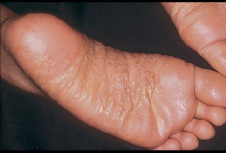 Dermatitis a lábak és annak okai