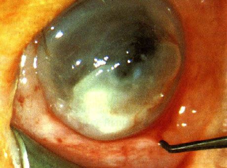 A Pseudomonas által okozott keratitis egy újszülöttben.  A prediszponáló tényezőket nem azonosítják