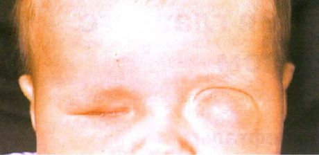 Microphthalmus egyidejű cyst kialakulásával (bal szem).  Anophthalmus (jobb szem).