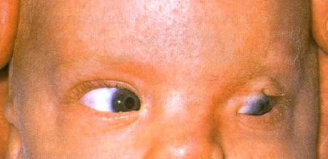 Fraser-szindróma.  A bal szem hiányos kriptophthalmusa.