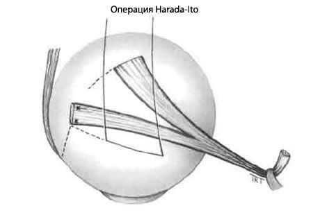 Strabismus - Működés