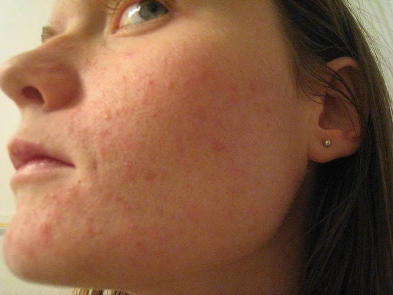 rosacea