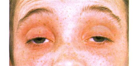 Külső ophthalmoplegia.  Kétoldalú ptózis.  A beteg szemöldöke felemeli a szemét