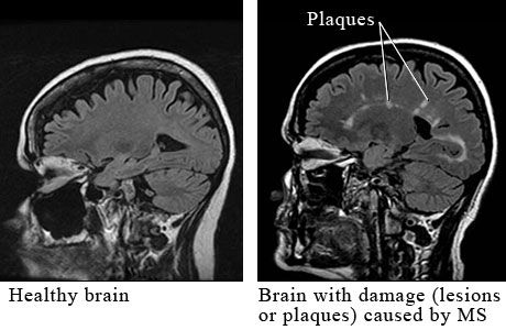 A sclerosis multiplex gyógyítható