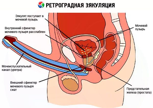 Általános prosztata - Prostatitis retrográd ejakuláció