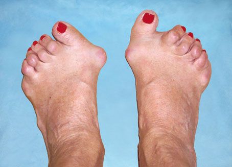rheumatoid arthritis lábujjak tünetei