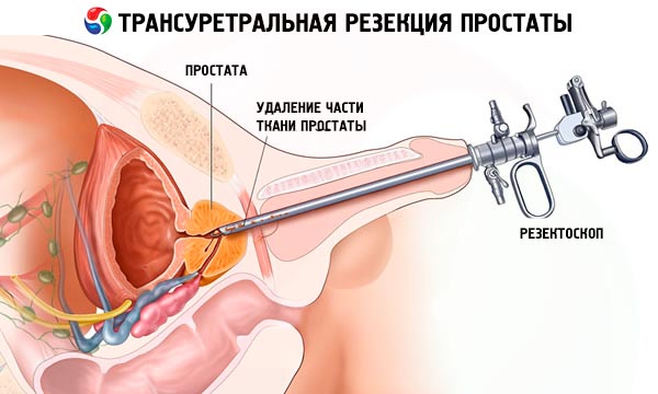 prosztata műtéti eljárások