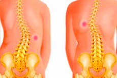 nyaki gerinc osteoarthritis kezelése a térdízület hátsó meniszkuszának kezelése
