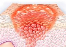 diagnosztikus intraductalis papilloma vastagbélrák 3. szint