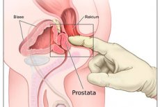 erős fájdalom a hátsó részben amikor prostatitis