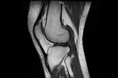 ízületi fájdalom az mri után fájdalom az ujjak ízületeiben az edzőterem után