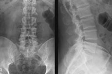 a lumbosacralis gerinc osteoarthritis