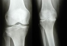 noduláris osteoarthritis)