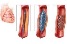 Angioplasztika és sztent