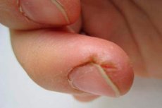 repedések az ujjak kezelése között