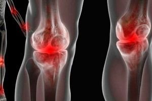 Szeronegatív arthritisek, Ízületi gyulladásos szindróma