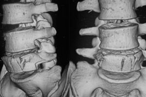 az ágyéki 1. fokú osteochondrosis