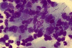 leukocyták a prosztatitis kenetben