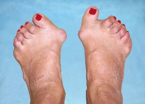 rheumatoid arthritis lábujj deformáció