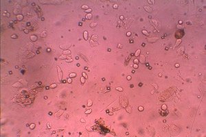 a prosztata vörösvérsejtek a vizeletben hogyan lehet meghatározni a prosztatitis vagy sem