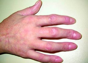 a kötőszövet szisztémás betegségei rheumatoid arthritis)