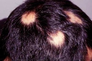 magas vérnyomás és alopecia