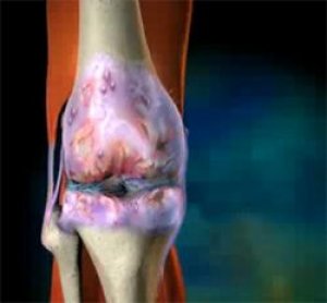 noduláris osteoarthritis ízületi gyulladás kezelése