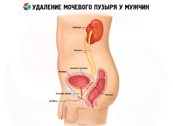 Húgyúti fertőzés szex után – sajnos nem véletlen - RMC Medicina - A Rózsakert Medical Center blogja