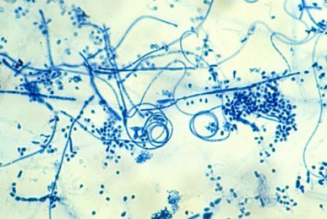 A lábak epidermofitózisának (Trichophyton interdigitale)