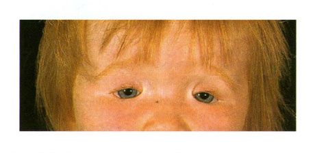 Kétoldalú coloboma a szemhéjakkal egy gyermeket Golden-szindrómával.  A szem zárása balra